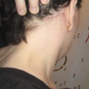 Week 5 close up of scar behind ear