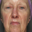CO2 Affrim Resurfacing