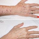 Age Spots And Sun Damage IPL Treatment