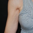 VASER Shape To Arms