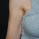 VASER Shape To Arms