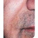 Artefill For Nasolabial Fold Repair