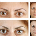 Botox Between The Eyes