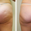 Velashape, After 5 Treatments