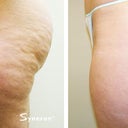 Velashape, After 5 Treatments