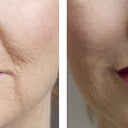  Collagen Injections