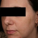 Melasma