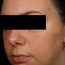 Melasma