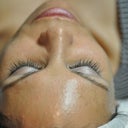 Chemical Peel