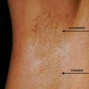 Laser Hair Removal Of Underarm 