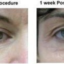 ActiveFX Laser Treatment For Facial Lines