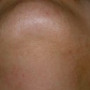 Chin Folliculitis And LHR