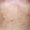Chin Folliculitis And LHR