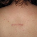 Back Lipoma Removal