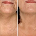 Before And After Restylane Perlane