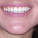 Full Lip