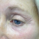 Portrait Plasma Resurfacing