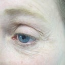 Portrait Plasma Resurfacing