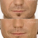 Restylane Male Nasolabial Folds Before After