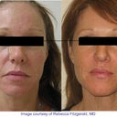 Sculptra Los Angeles