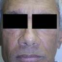 Silicone Microdroplet Therapy For Facial Atrophy