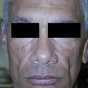 Silicone Microdroplet Therapy For Facial Atrophy