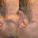 Facial Wasting Treatment For Volume Loss Resulting From HIV Antiviral Therapy