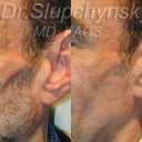 Facial Wasting Treatment For Volume Loss Resulting From HIV Antiviral Therapy