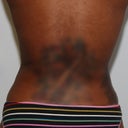 Smart Lipo