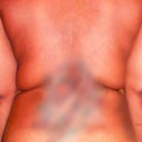 Smart Lipo