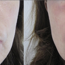 SmartXide Fractional CO2 Resurfacing