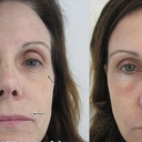 SmartXide Fractional CO2 Resurfacing