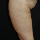 SmoothShapes Cellulite Treatment