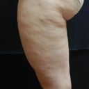SmoothShapes Cellulite Treatment