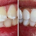 Teeth Whitening With Opalescence