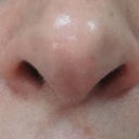 Nasolabial Injection