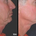 Thermage To Neck And Jaw Line