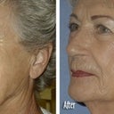 Threadlift To Full Face For Jaw And Neck Definition
