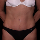 Tummy Tuck (Abdominoplasty)
