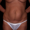 Tummy Tuck (Abdominoplasty)