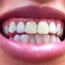 Zoom Whitening