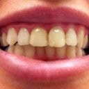 Zoom Whitening