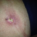 Infection of one of the Lipo Incision sites, under my left butt cheek.  PS prescribed some antibiotics for a few days  (17 days PO )
