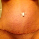 17 Days PO.   I don't like that my hips look uneven, hoping this is swelling and will go down in time.