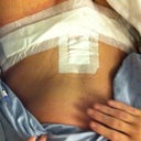 This is me Sam position hours after surgery