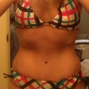 2 years post op