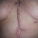 This is the top portion of my stomach.  You can see the t-shaped scar tissue between my breasts and the area where tissue had to be removed from my stomach from the infection I got during my last revision.  (Right after surgery, the scar was three inches from top to bottom, two inches across, and nearly two inches deep.)  The dark scar down the middle, from between my breasts to the infection scar is a "ridge" that’s about one-quarter inch high.  It never smoothed out after surgery.