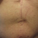 This is the mid to bottom portion of my stomach.  From top to bottom, you can see the infection scar, my so-called belly-button, and the uneven scar along the bottom of my stomach from my first procedure (body lift).  Also, after the second revision I noticed stretch marks around what should be my belly button (previous to the revision that skin was smooth without any stretch marks).