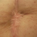 This is the infection scar, enlarged to show detail.