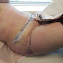Getting the drainage tubes taken out